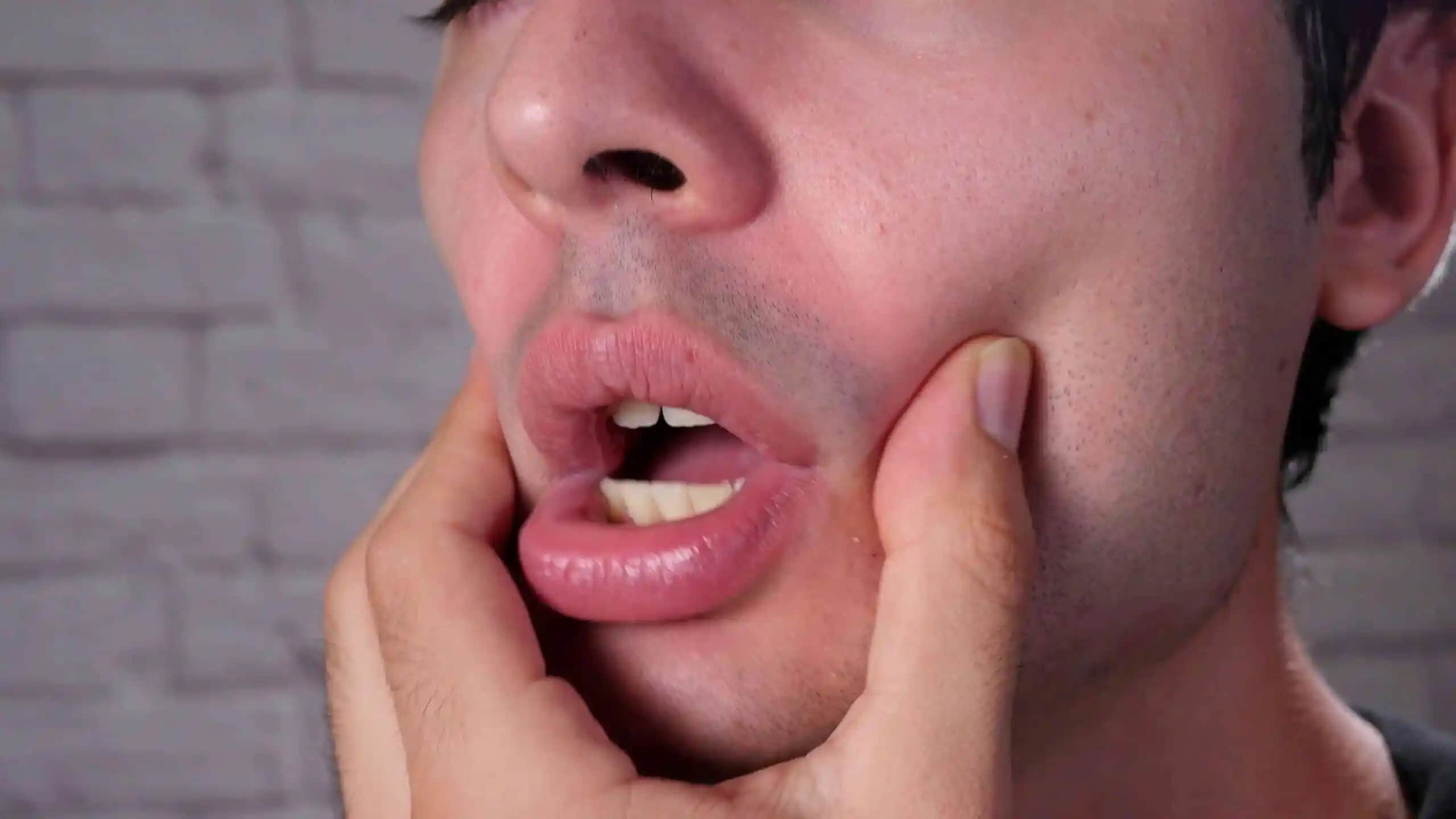 Dil Çatlağı Nedir, Nedenleri ve Tedavi Yöntemleri Hakkında Detaylı Bilgiler