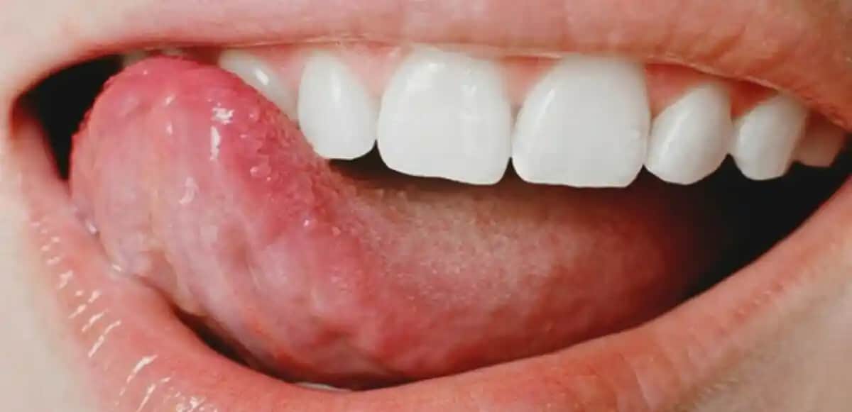 Dilde Beyaz Sivilceler: Nedenleri, Belirtileri ve Etkili Tedavi Yöntemleri