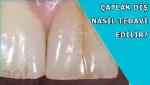 Diş Çizikleri ve Çatlakları: Estetik ve Sağlık Açısından Güncel Tedavi Yöntemleri