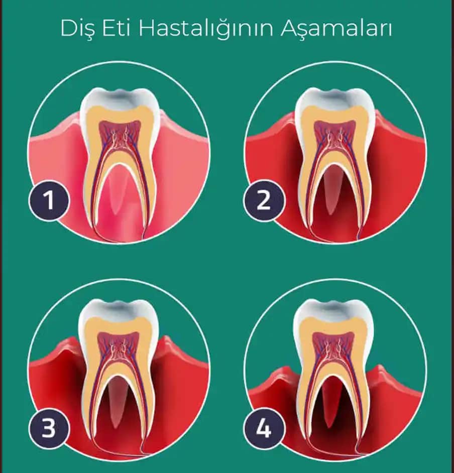 Diş Eti Merhemleri ve Ağız Sağlığını Koruma Yöntemleri Hakkında Kapsamlı Bilgi