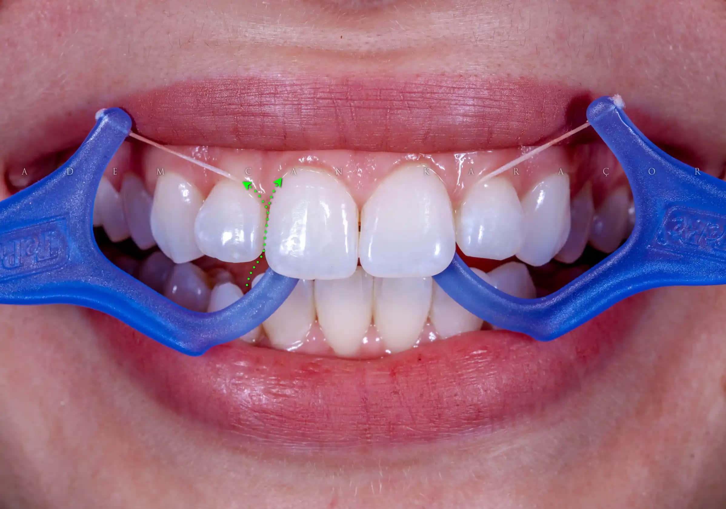 Diş İpi Kullanımının Önemi ve Doğru Seçim Yöntemleri