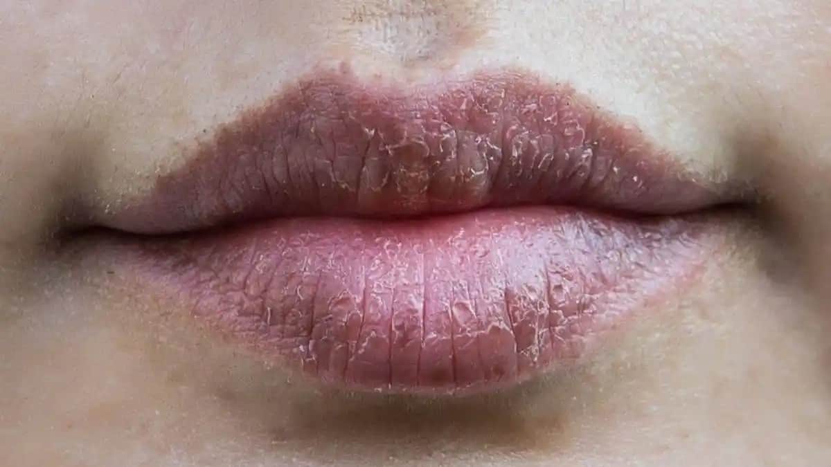 Dudak Çatlaması Nedenleri ve Etkili Doğal Çözüm Yöntemleri