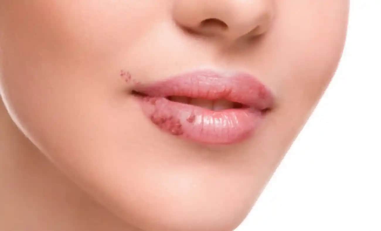 Dudak Mantarı Nedenleri, Belirtileri ve Etkili Tedavi Yöntemleri Hakkında Kapsamlı Bilgi