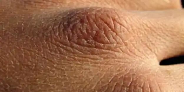 Elde Çatlaklara Karşı En Etkili Kremler ve Doğal Çözüm Yöntemleri