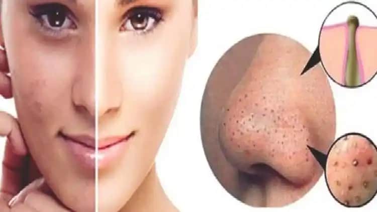 En Etkili Siyah Nokta Maskeleri ve Doğal Cilt Temizleme Yöntemleri