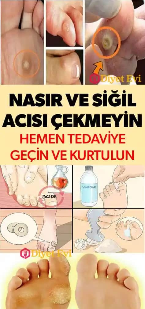 En İyi Nasıra Karşı Kozmetik Çözümler ve Profesyonel Tedavi Yöntemleri