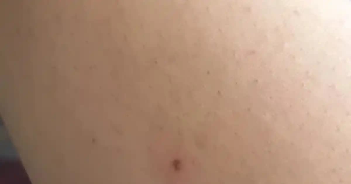 Epilasyon Sonrası Kızarıklık Nedenleri ve Hızlı Geçirme Yöntemleri