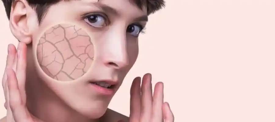 Ergenlikte Vücut Çatlakları: Nedenleri, Tedavi Yöntemleri ve Önleme İpuçları