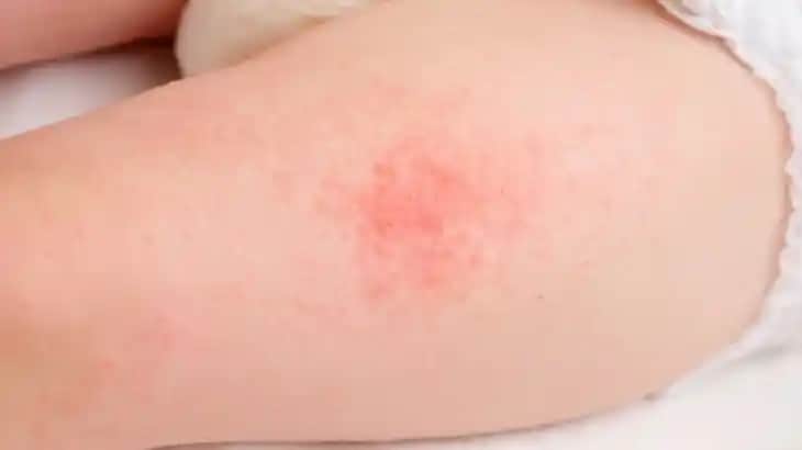 Erkeklerde Pişik Nedenleri ve Etkili Tedavi Yöntemleri Hakkında Bilgilendirici Rehber