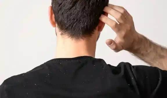 Erkeklerde Saç Kepeği Nasıl Geçer: Etkili Çözüm Yöntemleri ve Doğal Tavsiyeler