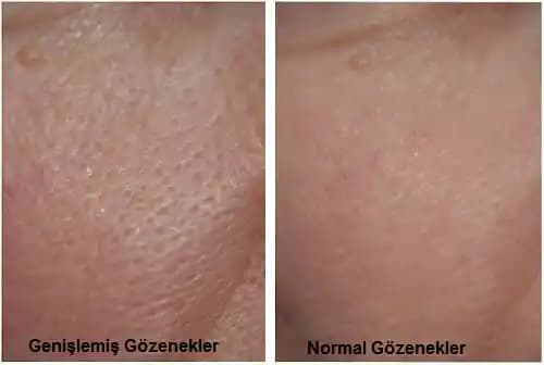 Genişlemiş Gözenekler Nedenleri ve Etkili Sıkılaştırma Yöntemleri