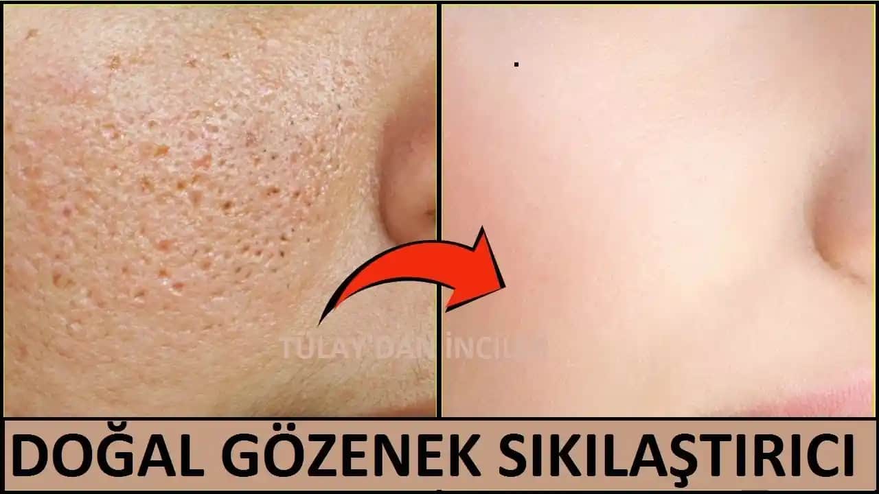 Gözenekleri Sıkılaştırıcı Etkili Yöntemler ve Doğal Çözümler