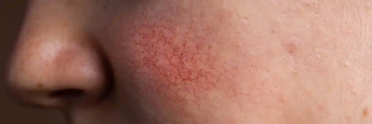 Gül Hastalığına İyi Gelen Kremler ve Cilt Bakım Yöntemleri Rehberi