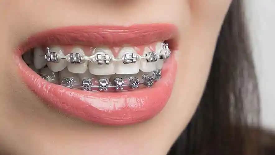 Gümüş Diş Kaplama Fiyatları ve Kozmetik Perspektiften Değerlendirme