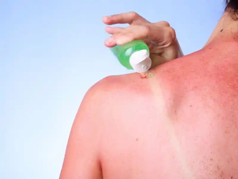 Güneş Yanığı İyileşme Süresi ve En Etkili Bakım Yöntemleri