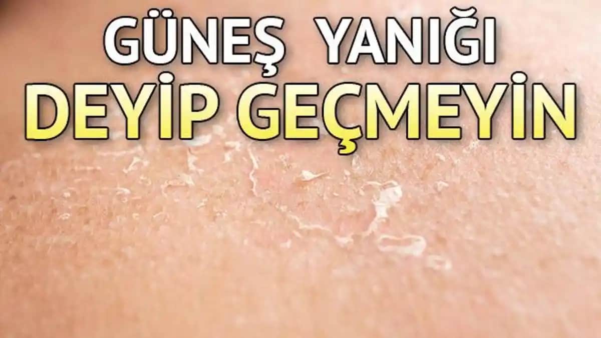 Güneş Yanığı Yüzü: Belirtileri, Korunma Yöntemleri ve Doğal Tedavi İpuçları