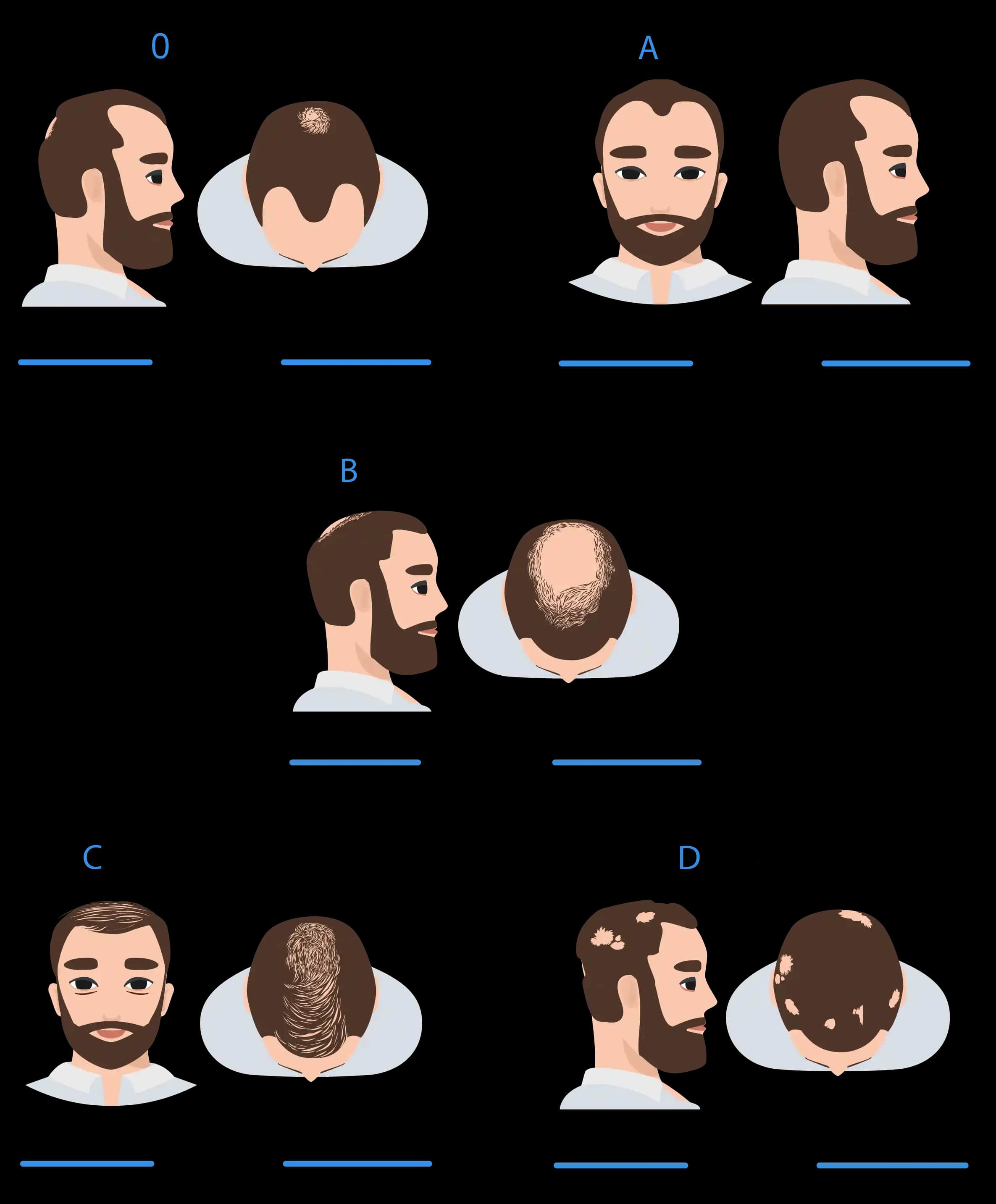 Günlük Saç Dökülme Miktarları ve Normal Dökülme Oranları Hakkında Bilgi