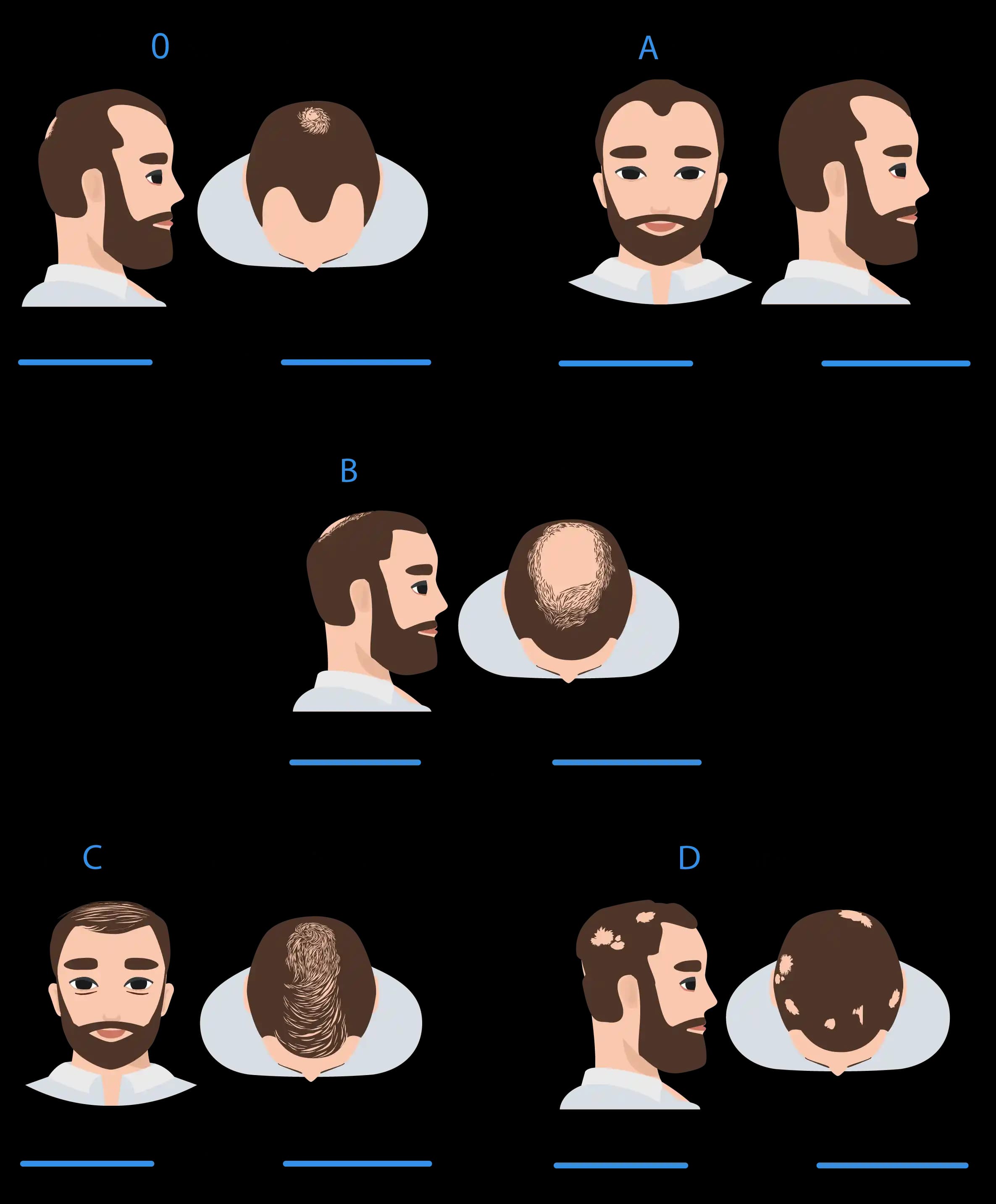 Günlük Saç Dökülme Miktarları ve Normal Dökülme Oranları Hakkında Bilgi