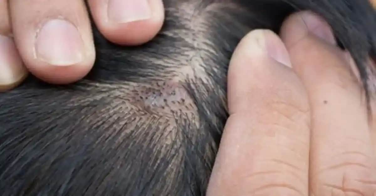 Kafa Derisinde Beyaz Kabuklanma Nedenleri ve Etkili Çözüm Yolları