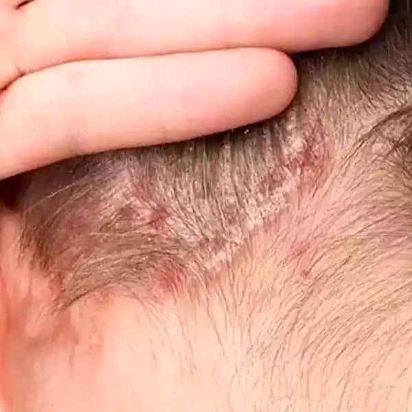 Kafa Derisinde Kabuklanma Nedenleri ve Etkili Tedavi Yöntemleri