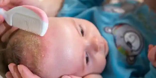 Kafa Derisinde Pullanma Nedenleri ve Etkili Tedavi Yöntemleri