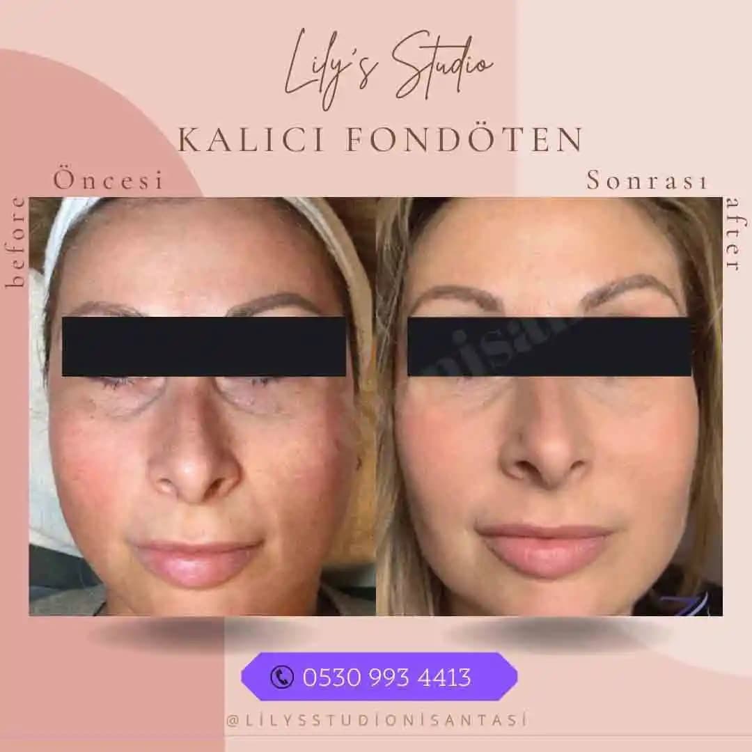 Kalıcı Fondöten Nedir, Nasıl Uygulanır ve Avantajları Nelerdir