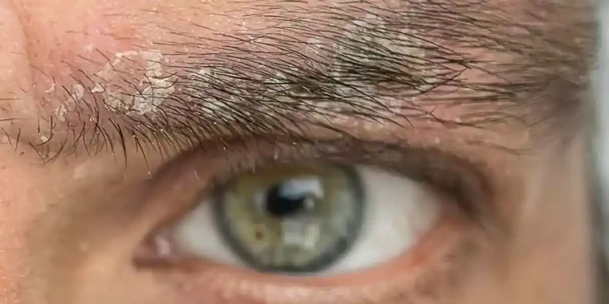 Kaş Kepeklenmesi Nedenleri ve Etkili Çözüm Yöntemleri Hakkında Kapsamlı Rehber