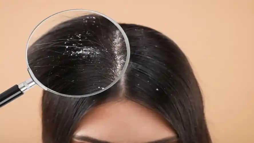 Kepeğe Karşı Evde Uygulanabilecek Doğal ve Etkili Yöntemler Hakkında Kapsamlı Rehber