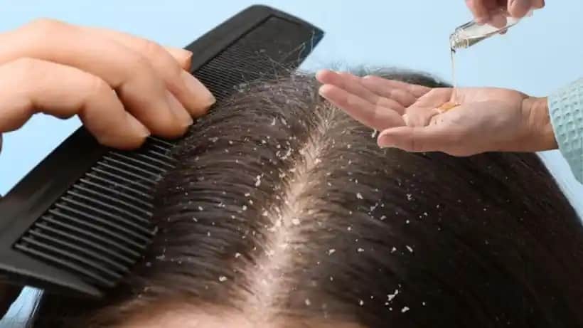 Kepek ve Kaşıntıya Karşı Etkili Doğal ve Kozmetik Çözümler Rehberi