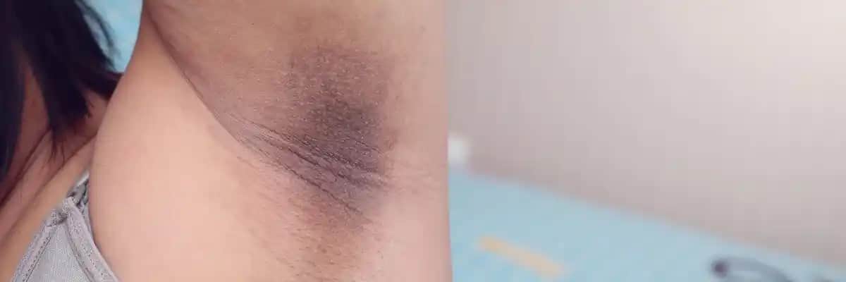 Koltuk Altı Kararması Nedenleri, Belirtileri ve Etkili Çözüm Yolları