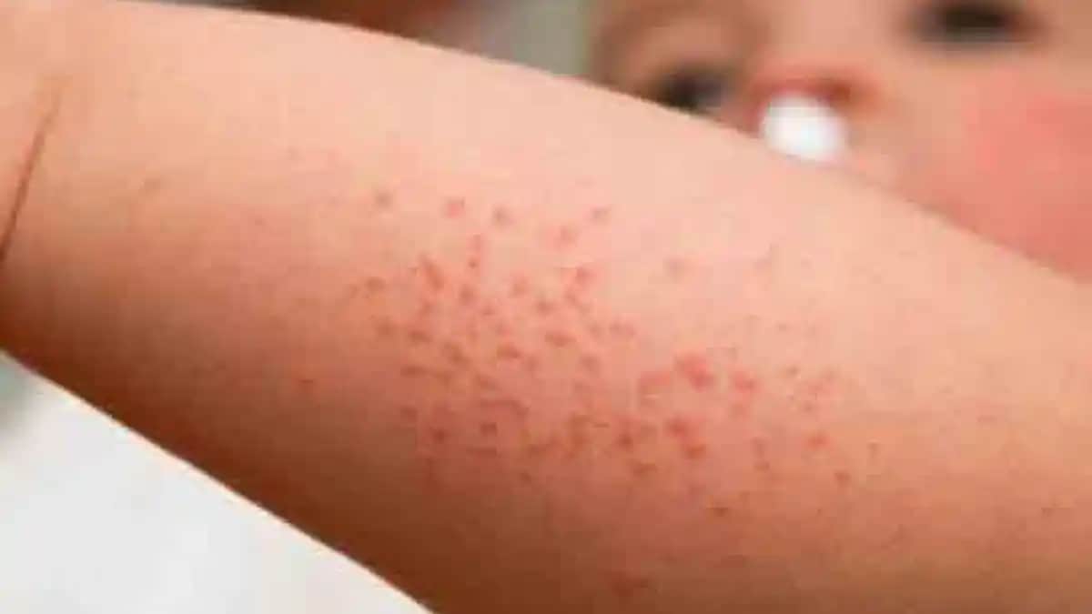 Koltuk Altı Pişiğine Karşı Etkili Doğal Yöntemler ve Önleyici Tavsiyeler