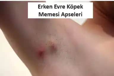 Koltuk Altı Sivilcelerini Önleme ve Doğal Çözüm Yöntemleri Rehberi