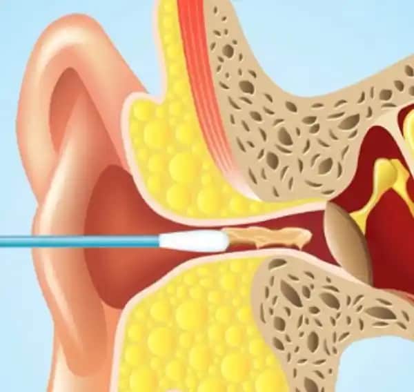 Kulak Çubuğu Kullanımı Güvenli mi Yoksa Sağlık Riski Taşıyor mu