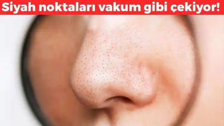 Siyah Noktalara Karşı Etkili ve Doğal Çözüm Yöntemleriyle Sağlıklı Cilt