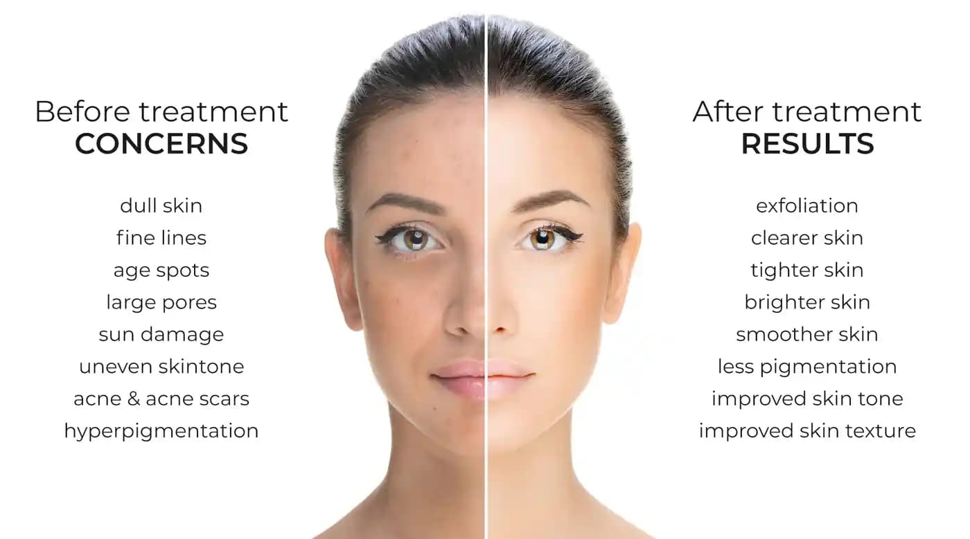 Yüz Peeling Nedir, Çeşitleri ve Cilt Sağlığına Faydaları Hakkında Kapsamlı Bilgi