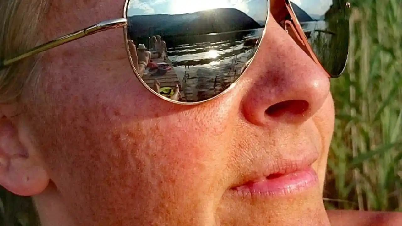 Güneş Lekeleri ve Doğru Bakım Yöntemleri Cilt Sağlığını Koruma Rehberi