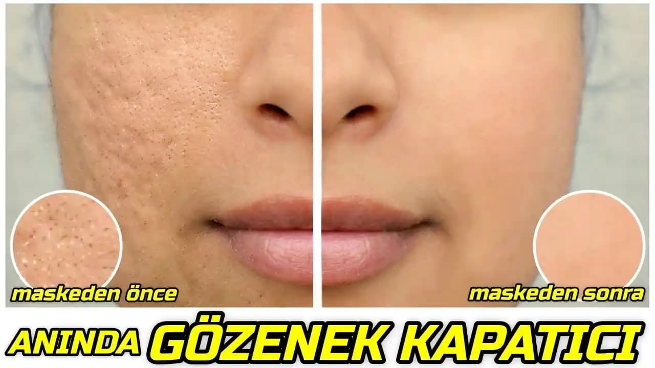 Kıl Gözenekleri Nasıl Kapanır ve Görünümünü Azaltmanın Etkili Yöntemleri