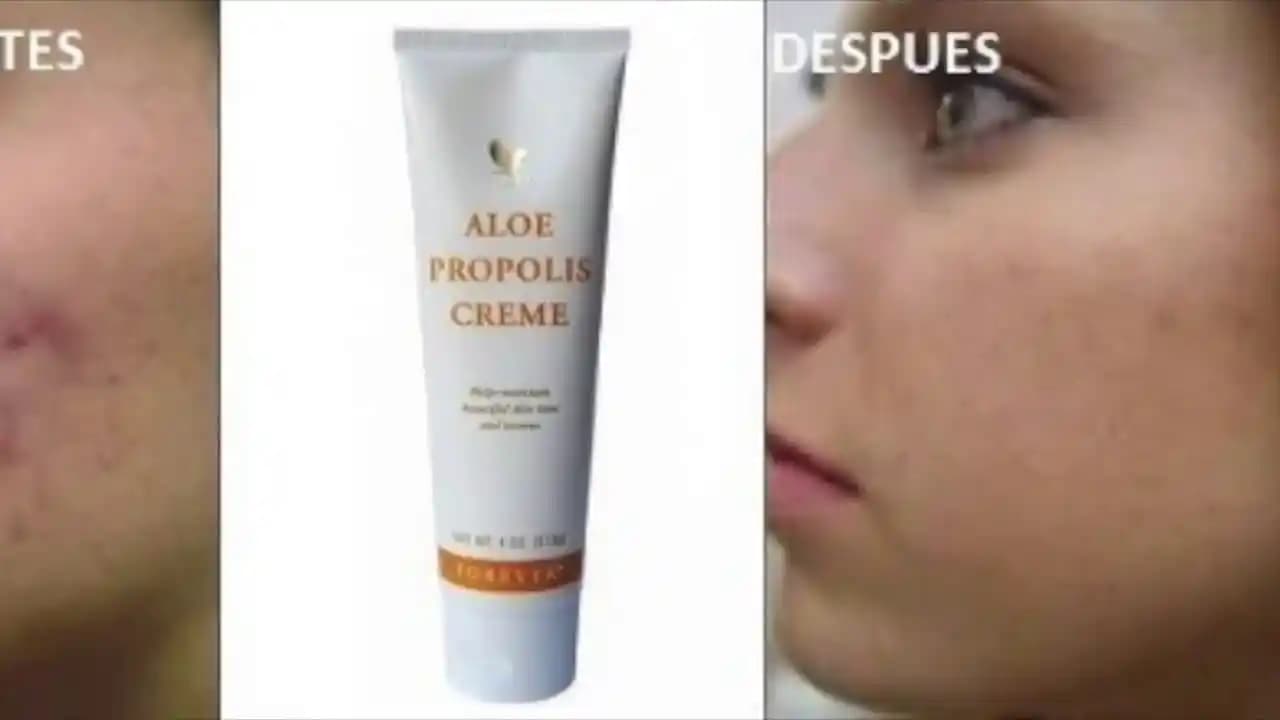 Propolis ve Sivilce: Doğal Çözüm Arayışında Güçlü Bir Alternatif