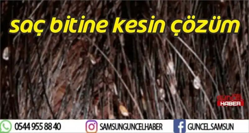Saç Bitlerine Karşı Etkili ve Güvenilir Çözüm Yöntemleri ve Temizlik İpuçları