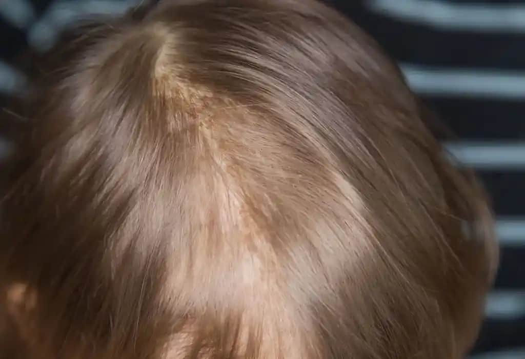 Saç Derisinde Kahverengi Lekeler: Nedenleri, Belirtileri ve Çözüm Yolları