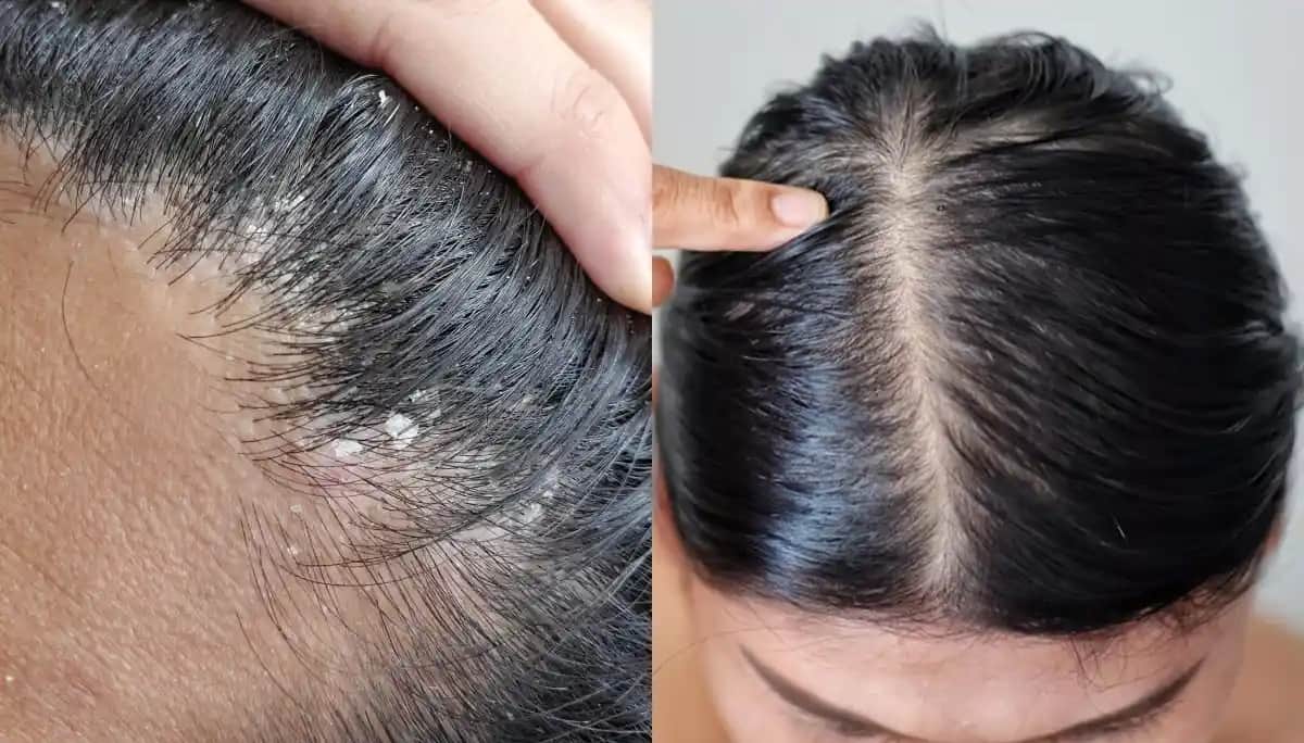 Saç Derisinin Kuruması Nedenleri Belirtileri ve Çözüm Yolları Hakkında Kapsamlı Bilgi