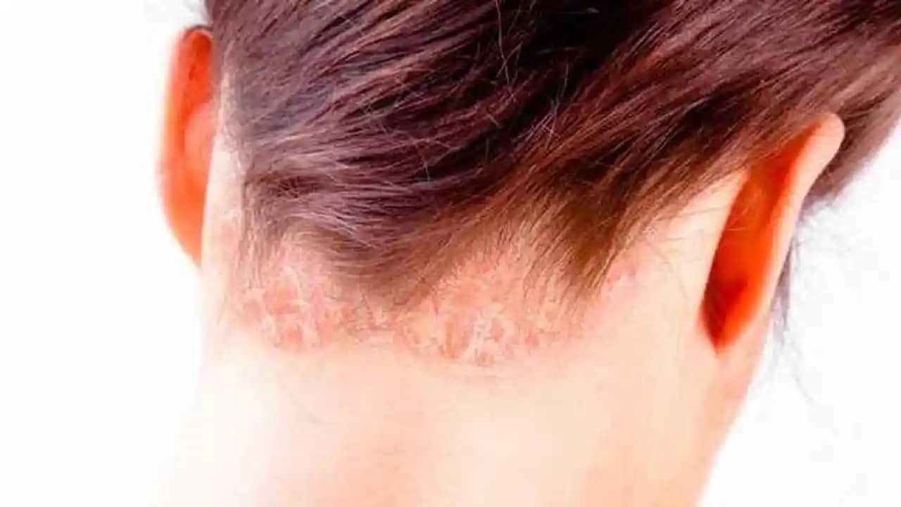 Saç Gözeneklerini Temizleme ve Sağlıklı Saçlar İçin Etkili Yöntemler