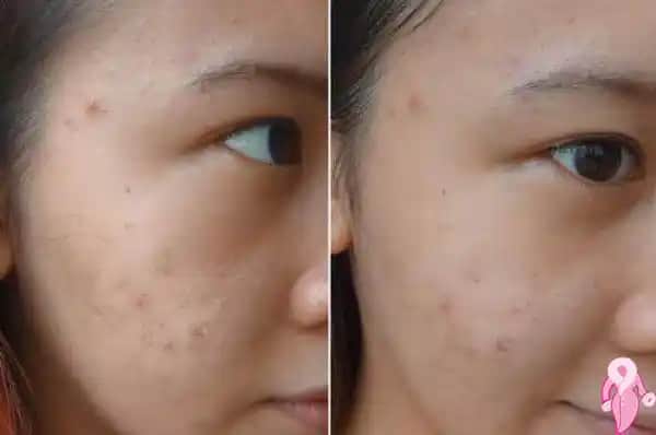 Sivilce Çukurları Gerçekten Geçer mi Cilt Sağlığı ve Tedavi Yolları