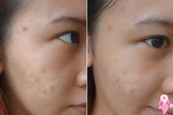 Sivilce Çukurları Gerçekten Geçer mi Cilt Sağlığı ve Tedavi Yolları