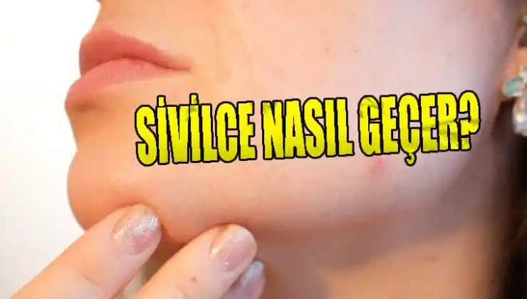 Sivilce Lekeleri Ne Kadar Sürede Geçer: Tedavi Süreçleri ve İpuçları