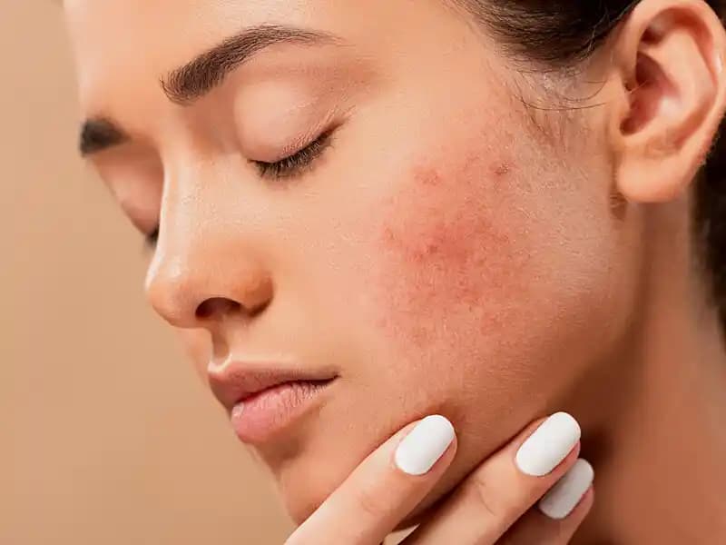 2025'te Sivilce Sonrası Kırmızı Lekelerden Kurtulmanın 5 Etkili Yolu