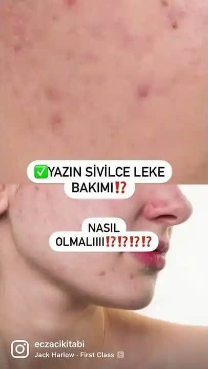 Sivilce Sonrası Lekelerin Azaltılması İçin Etkili Cilt Bakım Yöntemleri ve Tavsiyeler