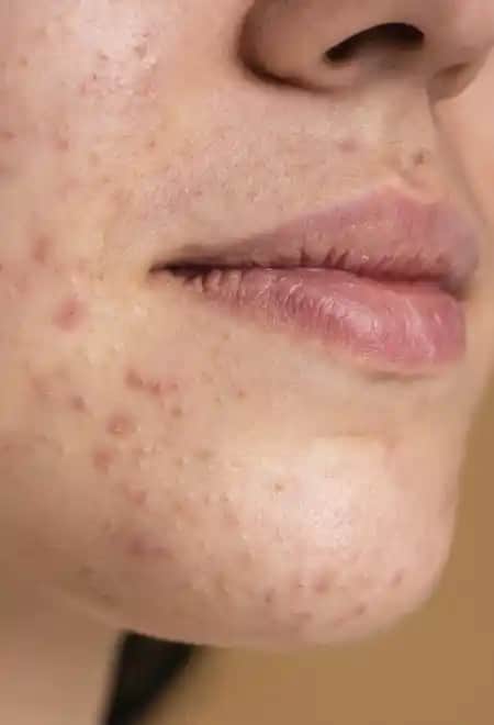 Sivilce Sonrası Siyah Lekeleri Azaltmak İçin Etkili Cilt Bakım Yöntemleri ve Profesyonel Tedavi Seçenekleri