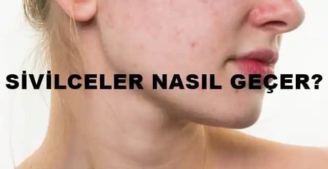 Sivilceler Ne Zaman Geçer ve Etkili Çözüm Yöntemleri Nelerdir