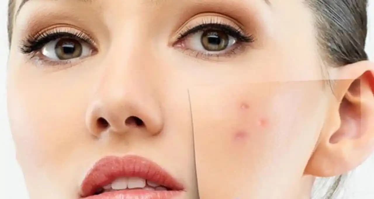 Sivilcenin Geçme Süresi ve Sağlıklı Cilt İçin Doğru Yaklaşımlar